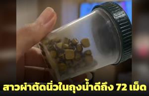 อุทาหรณ์! สาวผ่าตัดนิ่วในถุงน้ำดีถึง 72 เม็ด คาดสาเหตุดื่มชานมไข่มุกวันละ 2-3 แก้วเป็นเวลานาน