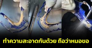 อึ้ง! สภาพหินปูนเกาะรีเทนเนอร์ หมอแนะ ทำความสะอาดกันด้วย
