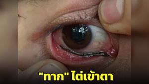 ไวรัลภาพสุดขนลุก! "ทาก" ไต่เข้าตา แนะสายเดินป่าพกเกลือ-น้ำเกลือ ติดตัวช่วยได้