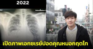 เปิดภาพเอกซเรย์ปอดหมอกฤตไท พบปอดข้างขวาหายครึ่งหนึ่ง จี้หน่วยงานแก้ปัญหาฝุ่นพิษจริงจัง