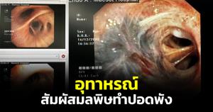อุทาหรณ์! ผู้ป่วยสัมผัสฝุ่นควันยาวนาน ทำหลอดลมดำ ปอดพัง