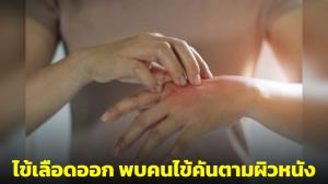 หมอมนูญเตือนระวังช่วงนี้โรคไข้เลือดออกระบาด เผยพบเคสผู้ป่วยมีอาการคันตามผิวหนัง