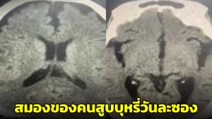 หมอสมองเผยภาพเอกซเรย์ชวนอึ้ง! สมองอาม่า 90 ปี กับคนสูบบุหรี่วันละซอง อายุแค่ 66 ปี (ชมคลิป)