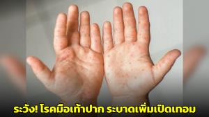 หมอยงเตือน! ระวังโรคมือ เท้า ปาก มีแนวโน้มระบาดเพิ่มช่วงหลังเปิดเทอม