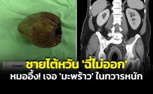 ชายไต้หวันบ่น ‘ฉี่ไม่ออก’ หมออึ้ง! เจอ ‘มะพร้าวทั้งลูก’ ติดคาทวารหนัก