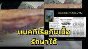 “หมอยง” ชี้ แบคทีเรียกินเนื้อเกิดกับคนภูมิคุ้มกันต่ำ แต่รักษาได้
