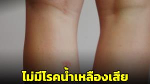 “หมอแล็บฯ” ยันโรคน้ำเหลืองเสีย ที่จริงมันคือ ‘ผิวหนังติดเชื้อแบคทีเรีย’