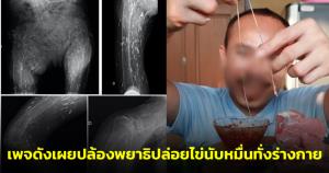 เพจดังอธิบายชัด หลังอินฟลูฯ กิน “พยาธิตัวตืด” โชว์ เผยปล้องพยาธิปล่อยไข่นับหมื่นทั่วร่างกาย