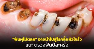 "ฟันผุไม่ตลก" อาจนำไปสู่โรคลิ้นหัวใจรั่ว แนะตรวจฟันปีละครั้ง