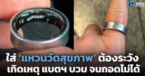ใส่ ‘แหวนวัดสุขภาพ’ ต้องระวัง แบตฯ บวมถอดไม่ได้