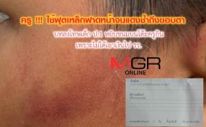 เห็นแล้วรับไม่ได้!ลูกศิษย์ ป.1 หยิบขนมกินไม่บอก ครูลำปางคว้าฟุตเหล็กฟาดหน้าเด็ก 7 ขวบ