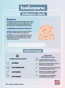 โรคผื่นกุหลาบ