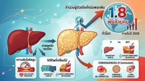 วิกฤตสุขภาพโลก! คาดปี 2050 ป่วย ‘ไขมันพอกตับ’ พุ่ง 1.8 พันล้านคน แนะ 5 วิธีดูแลตัวเองก่อนจะสาย