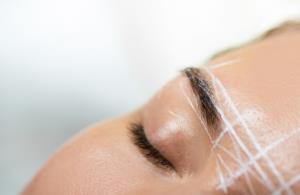 ยกหางตาซ่อนแผลใต้คิ้วด้วย Subbrow Lift เหมาะกับใครบ้าง