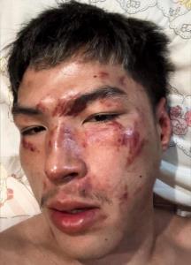 “ยอดไอคิว" เผยสภาพใบหน้าหลังไฟต์เดือดบดชนะ "เคียมรัน" แบบเลือดสาด