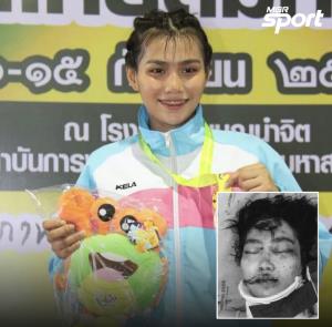 “เกตมณี” แชมป์มวยซีเกมส์ประสบอุบัติเหตุหนัก เลือดคั่งสมอง เสี่ยงมองไม่เห็น แฟนหนุ่มวอนช่วยค่ารักษา