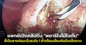 ขนลุก! แพทย์เปิดคลิปดึง "พยาธิใบไม้ในตับ" ชี้เป็นสารก่อมะเร็งระดับ 1 ย้ำเตือนเลี่ยงกินดิบเด็ดขาด