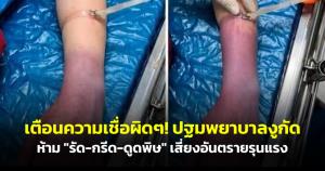 เตือนความเชื่อผิดๆ! ปฐมพยาบาลงูกัดห้าม "รัด-กรีด-ดูดพิษ" เสี่ยงอันตรายรุนแรง