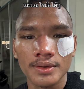 “เละเลยโรนัลโด้กู” แสงอาทิตย์ โพสต์เย็บ 5 เข็ม หลังจบไฟต์เดือดพ่าย โลแกน