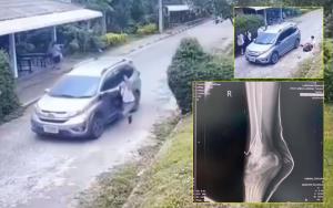 (คลิป)พ่อพาลูกชายหอบคลิปร้องสื่อ! ครูขับรถชนลูกขาหักคาโรงเรียนฯลี้ ไร้เยียวยา-ท้าอยากได้ไปฟ้องเอา