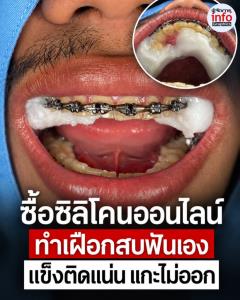 เตือนภัย! เฝือกสบฟัน ซื้อวัสดุออนไลน์ทำเอง เสี่ยงอันตรายในช่องปาก